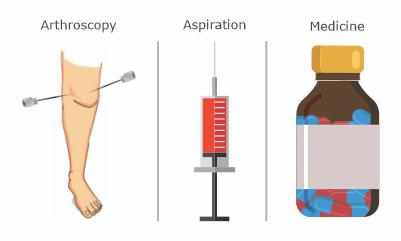 Treatment-Knee-Effusion