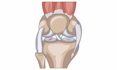 knee-pain-due-to-meniscal-tear